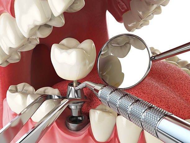 Best Cracked Tooth Emergency Dentist  in Gleed, WA